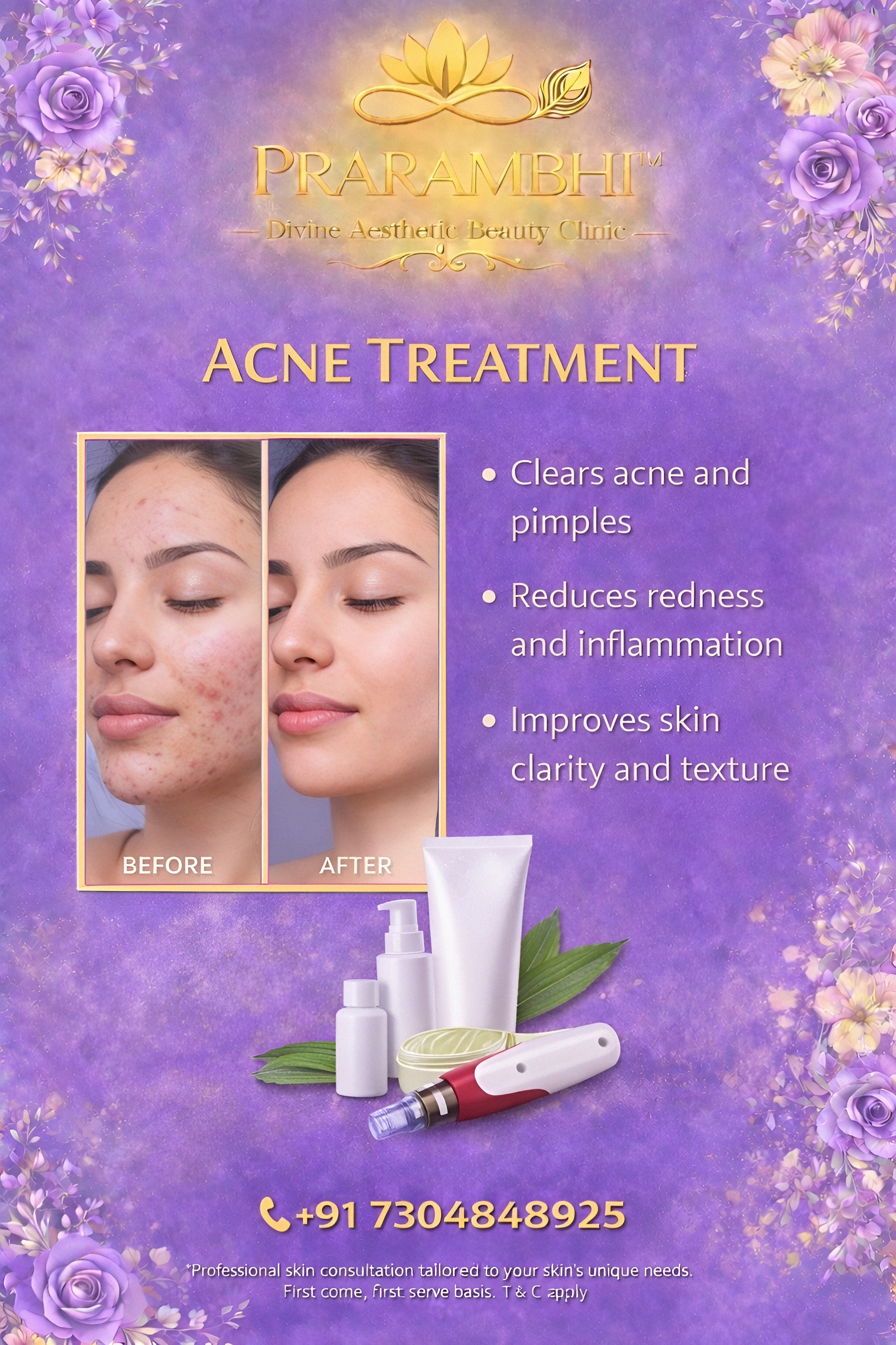 acne treatment